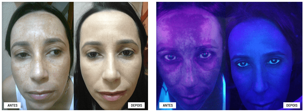 Antes e Depois - Tratamento Manchas Adélia Mendonça